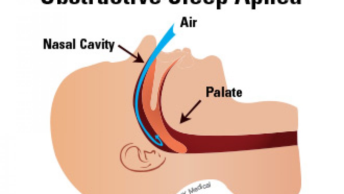 Sleep Apnea Treatment __Sunrise Dental | Chapel Hill | Durham | Raleigh | Cary, NC
