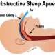 Sleep Apnea Treatment __Sunrise Dental | Chapel Hill | Durham | Raleigh | Cary, NC